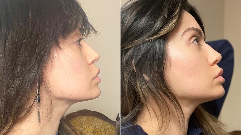 Prima e dopo l'utilizzo di Omnilux Contour Face