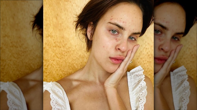 Tallulah Willis mostra lesioni cutanee