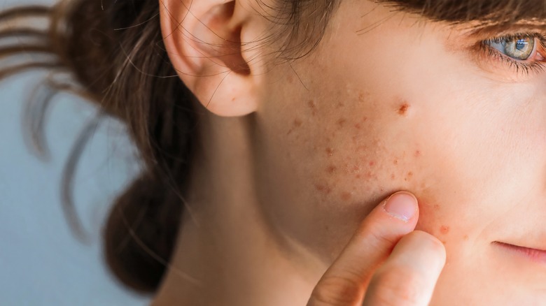 Primo piano della modella che applica il trattamento per l'acne