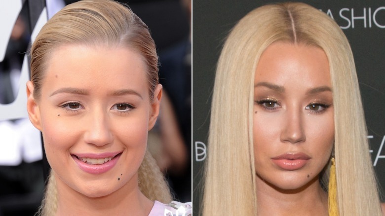 Foto affiancate di Iggy Azalea sorridente prima e dopo il suo lavoro al naso